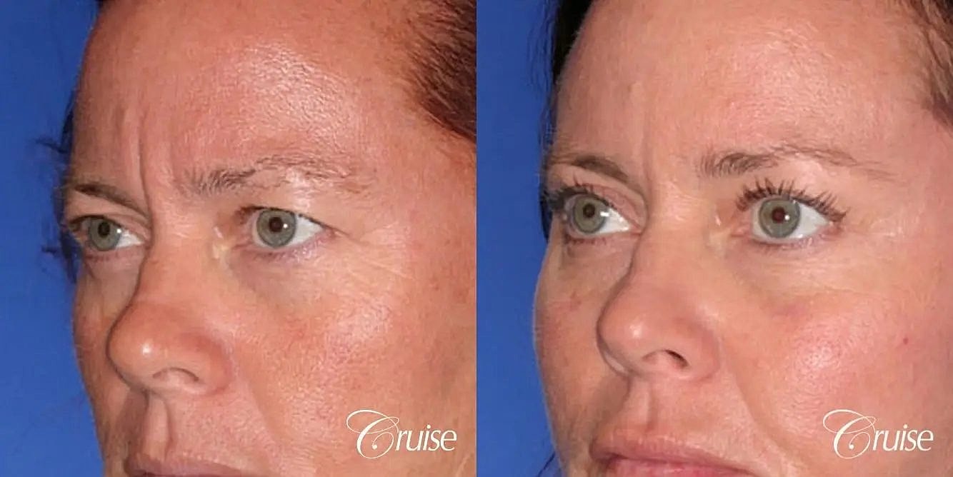 Blepharoplasty Before & After