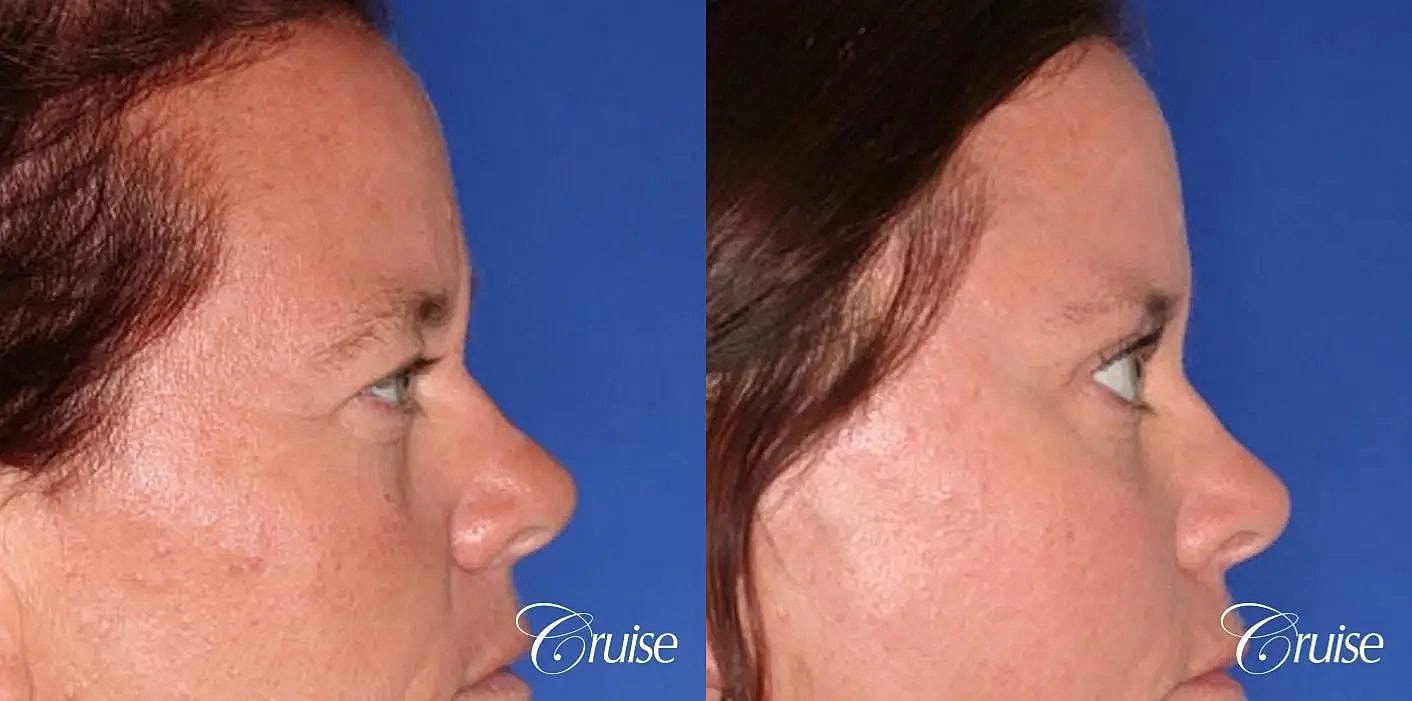 Blepharoplasty Before & After