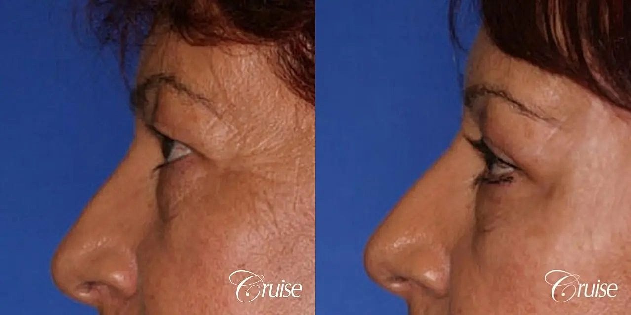 Blepharoplasty Before & After