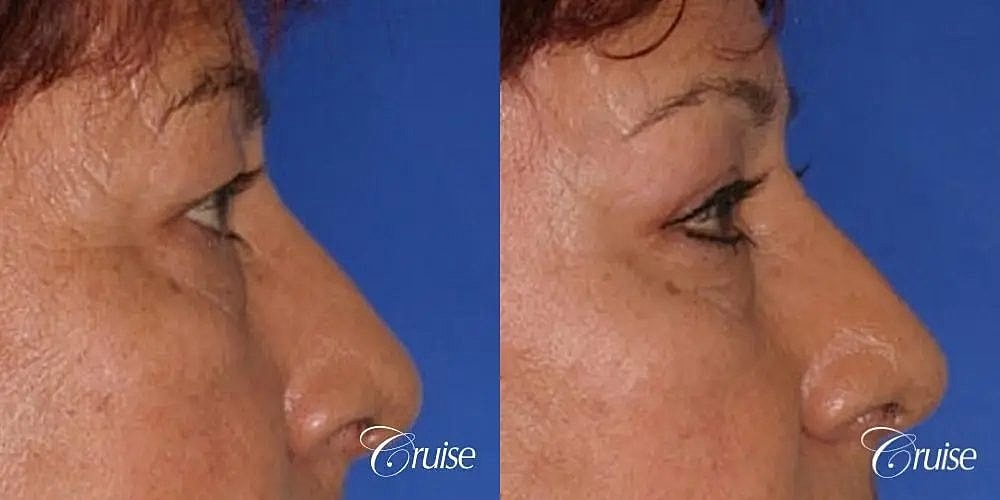 Blepharoplasty Before & After