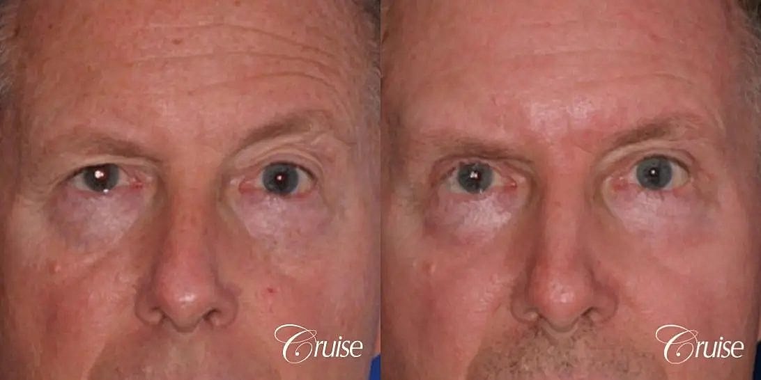 Blepharoplasty Before & After