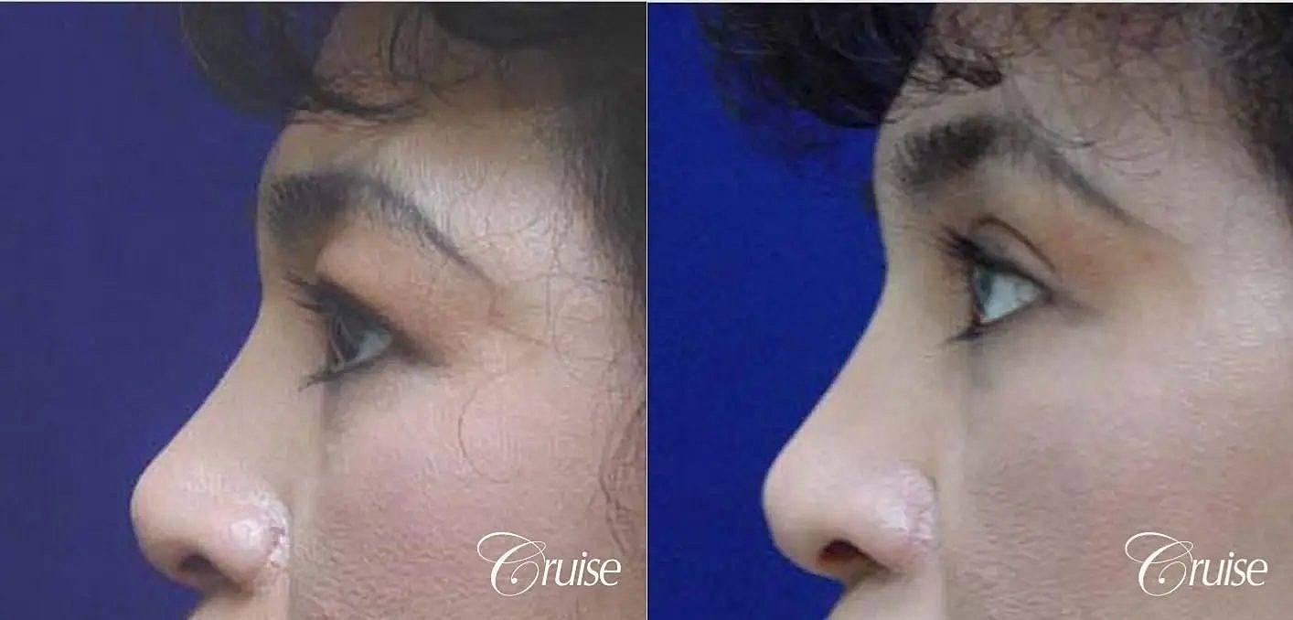 Blepharoplasty Before & After