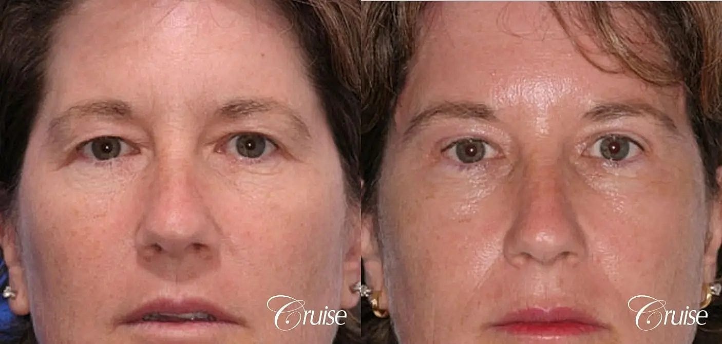 Blepharoplasty Before & After