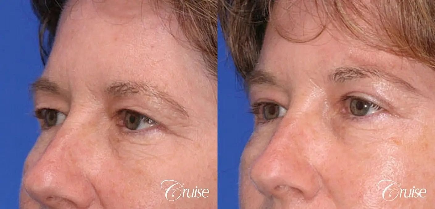 Blepharoplasty Before & After