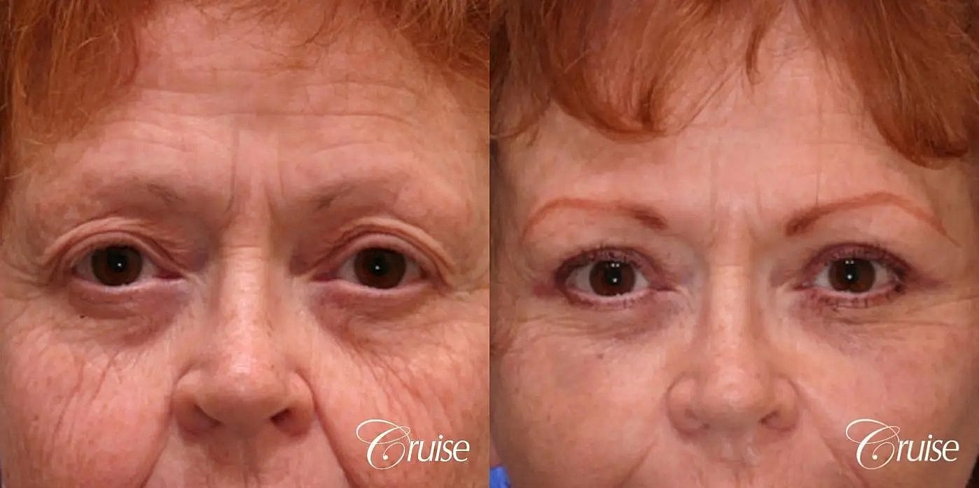 Blepharoplasty Before & After