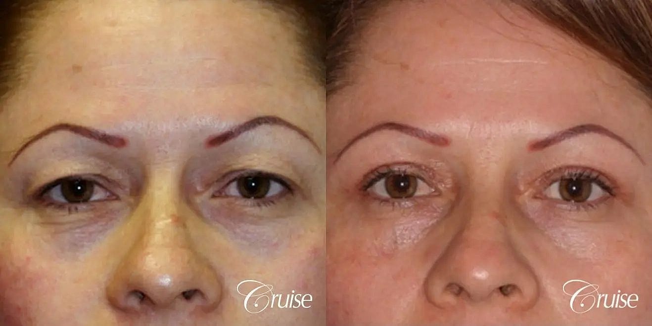 Blepharoplasty Before & After