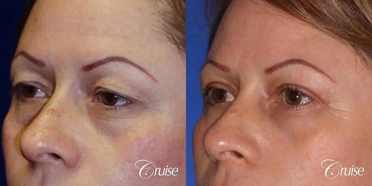 Blepharoplasty Before & After