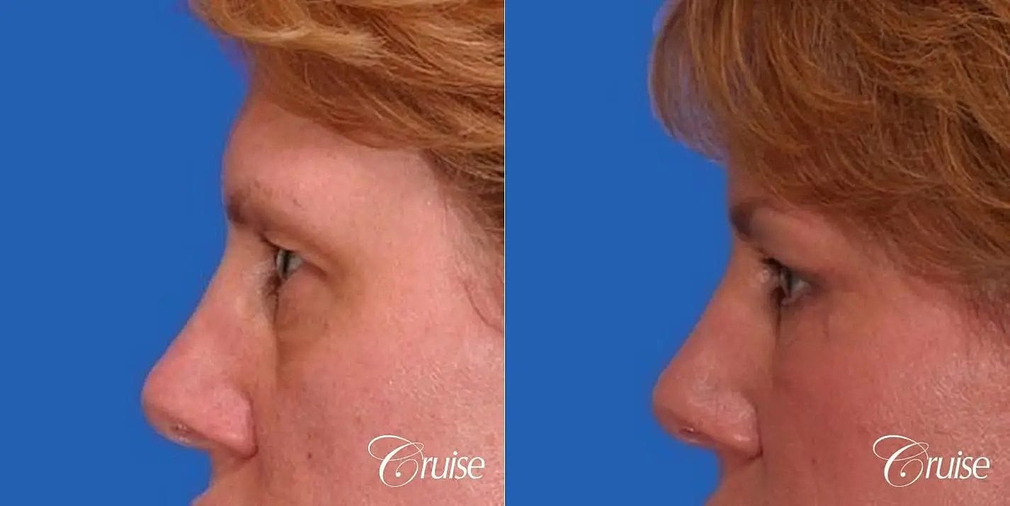 Blepharoplasty Before & After