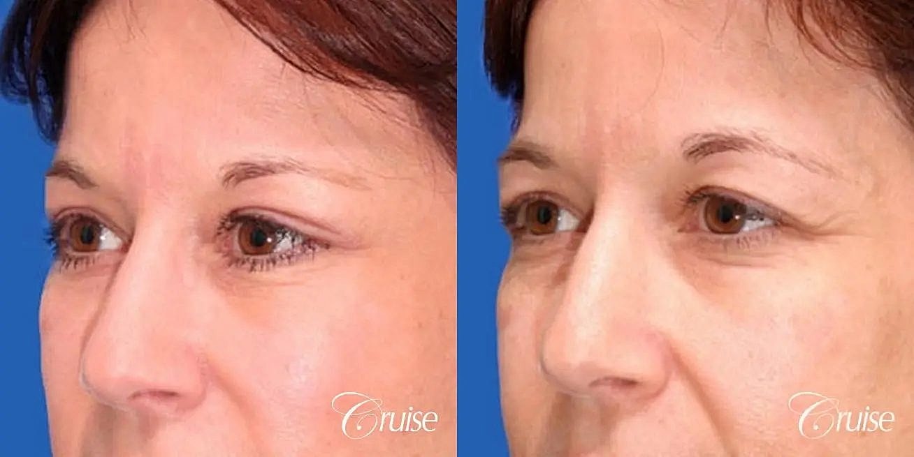 Blepharoplasty Before & After