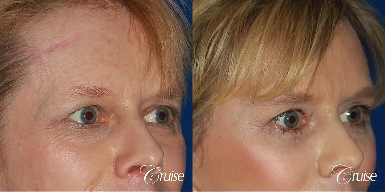 Blepharoplasty Before & After