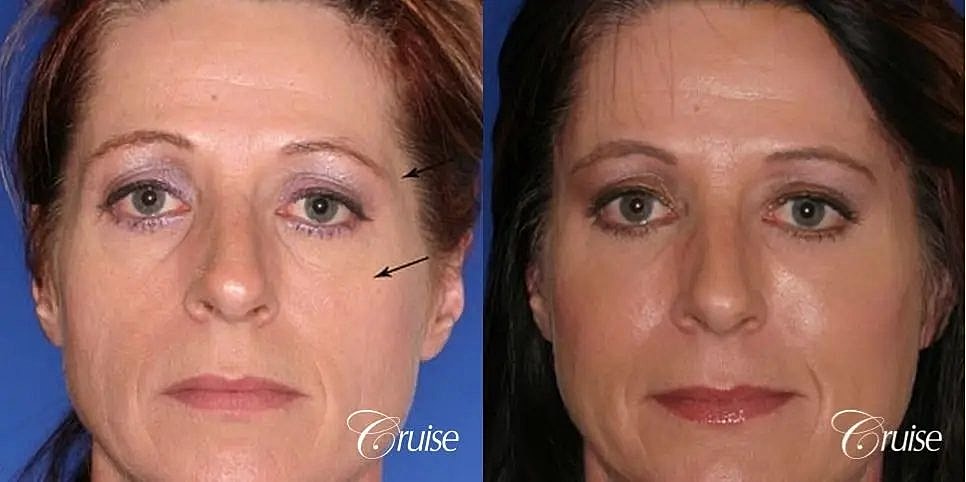 Blepharoplasty Before & After