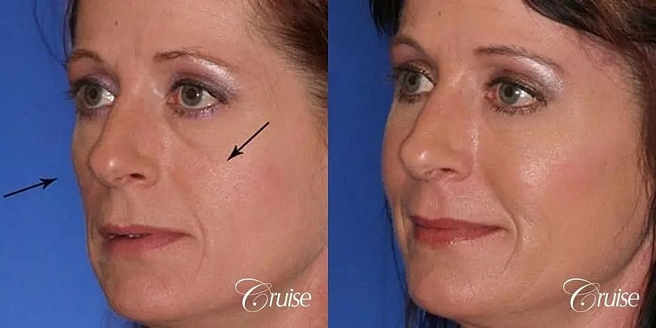 Blepharoplasty Before & After