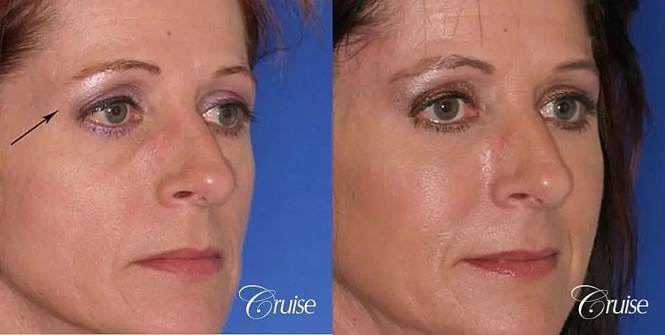 Blepharoplasty Before & After