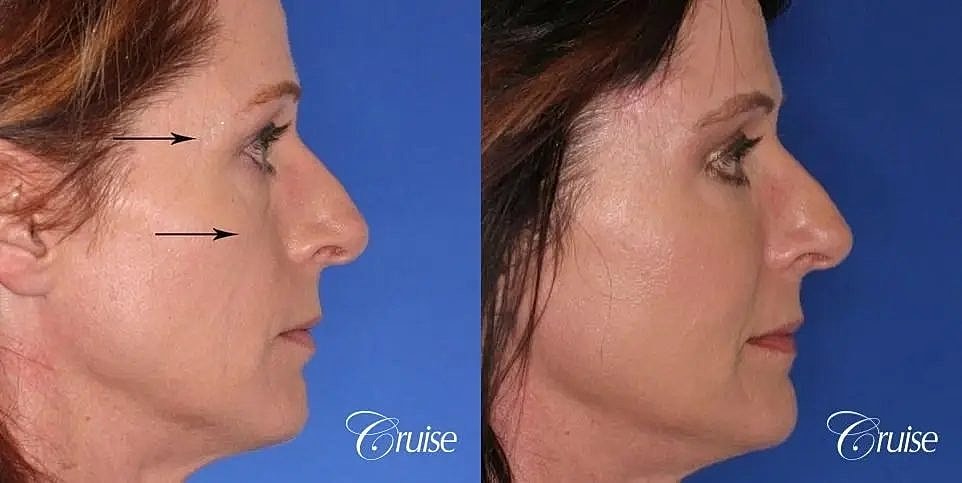 Blepharoplasty Before & After