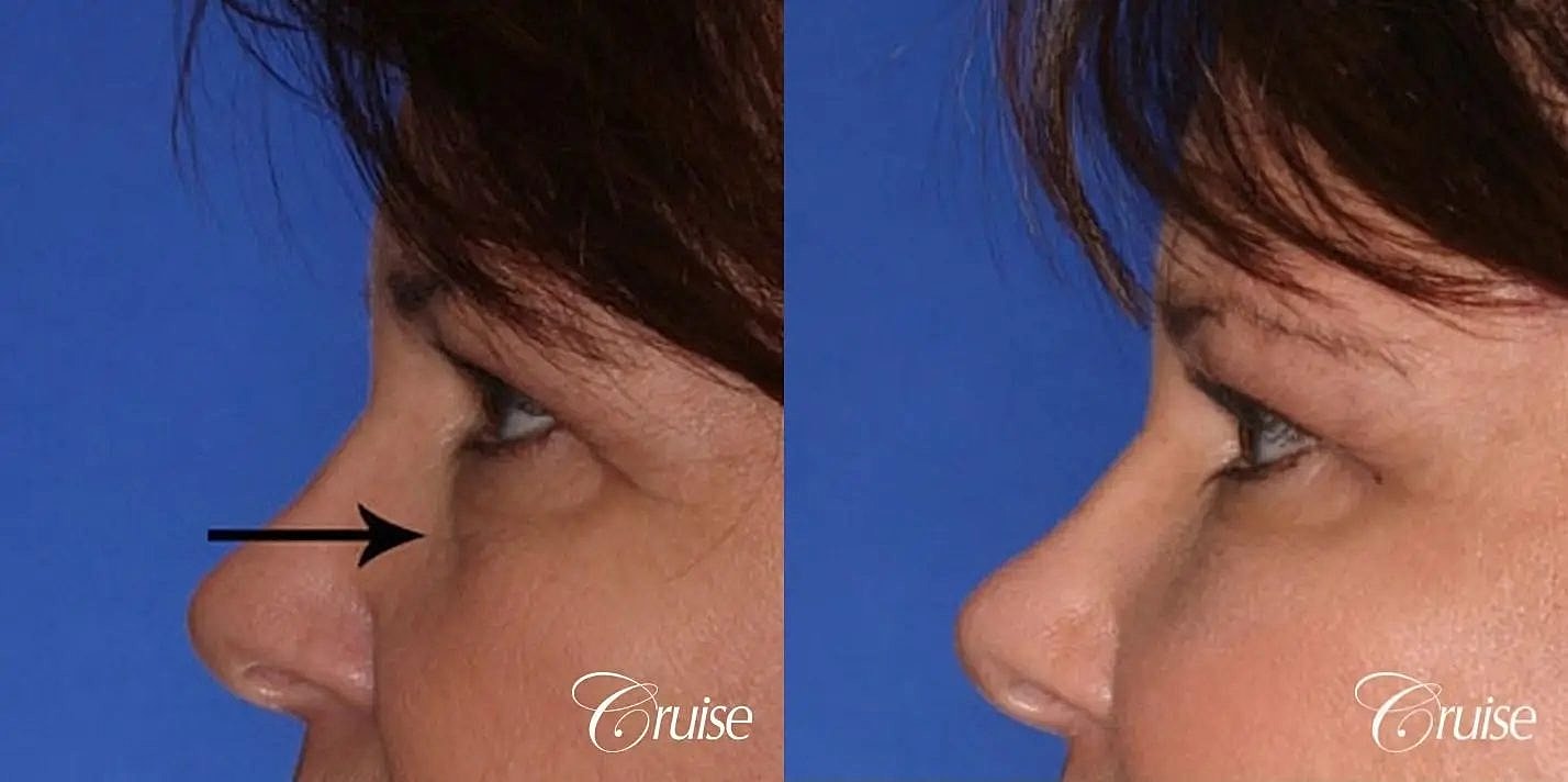 Blepharoplasty Before & After