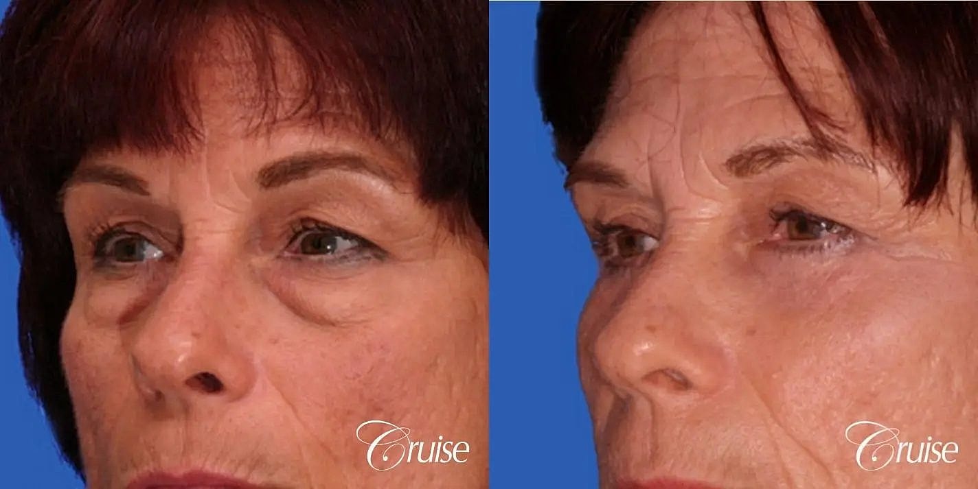 Blepharoplasty Before & After