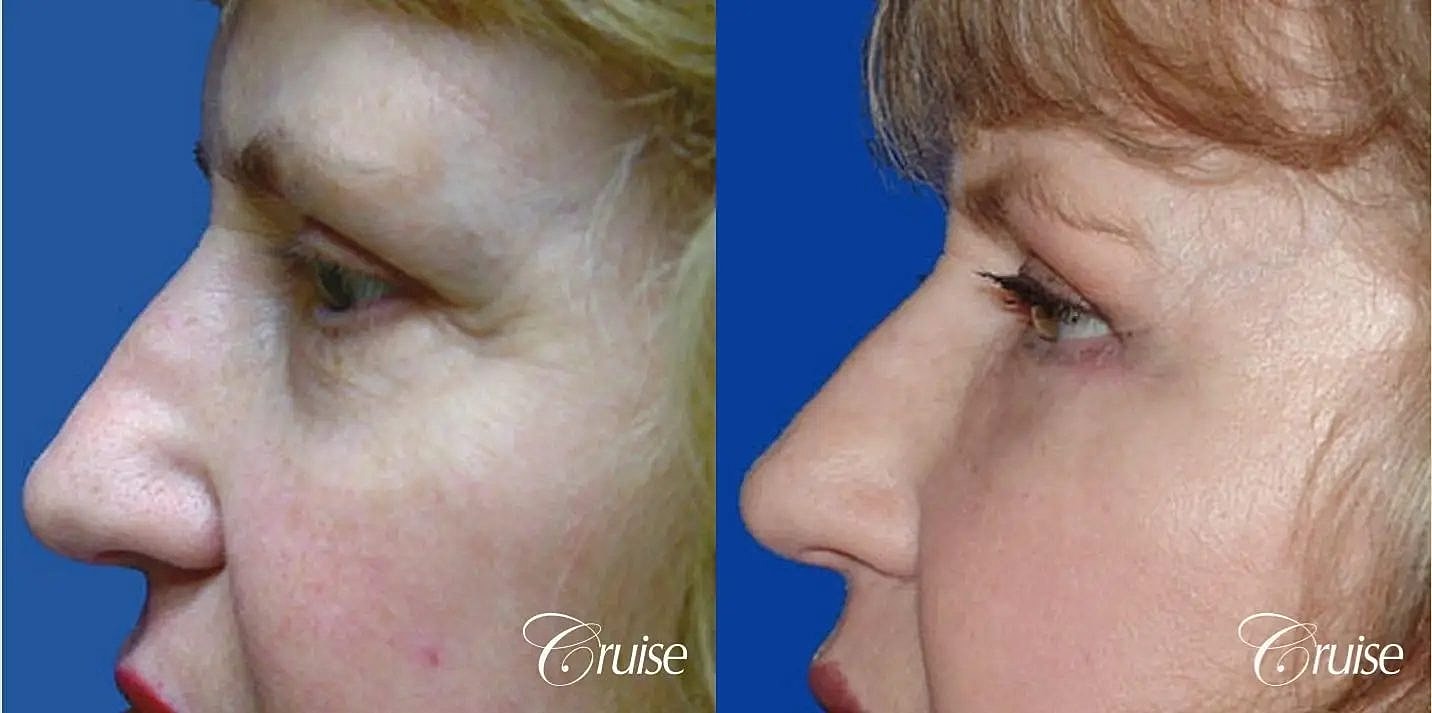 Blepharoplasty Before & After