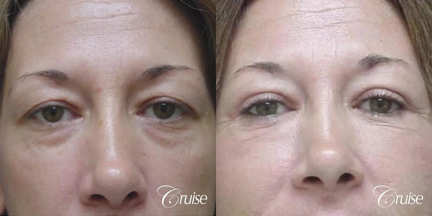 Blepharoplasty Before & After