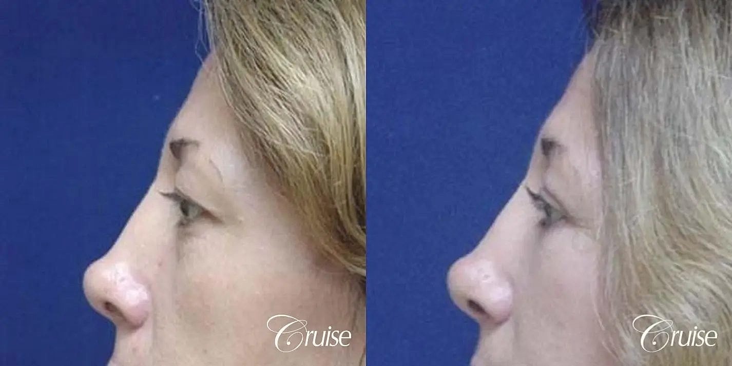 Blepharoplasty Before & After