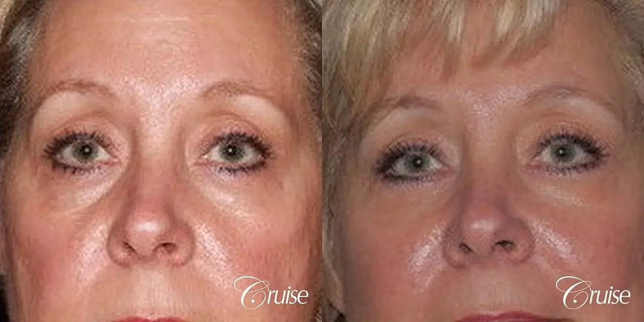 Blepharoplasty Before & After