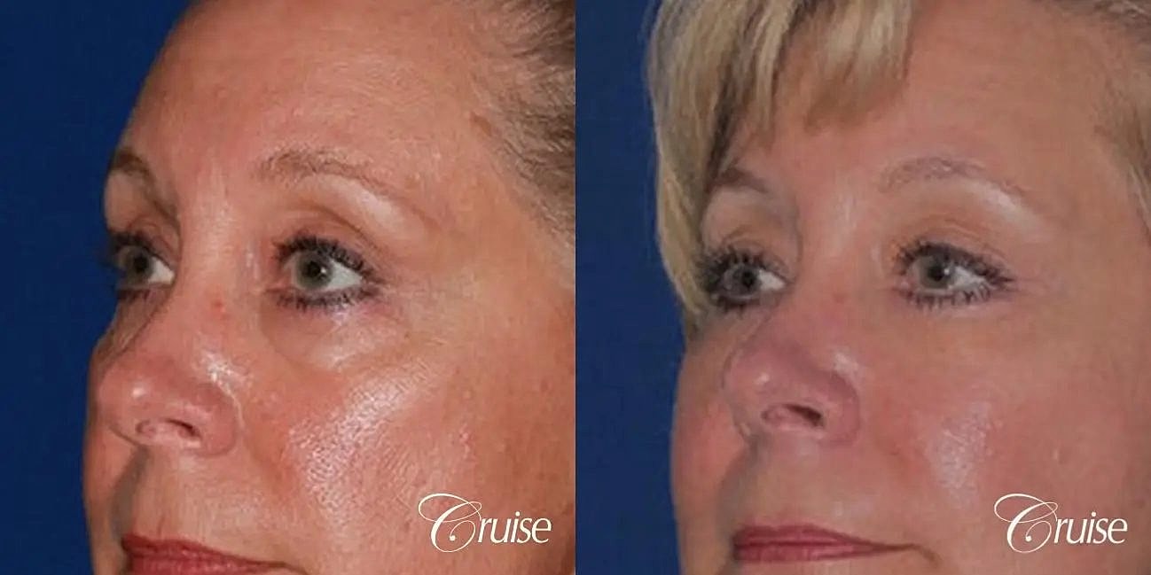 Blepharoplasty Before & After