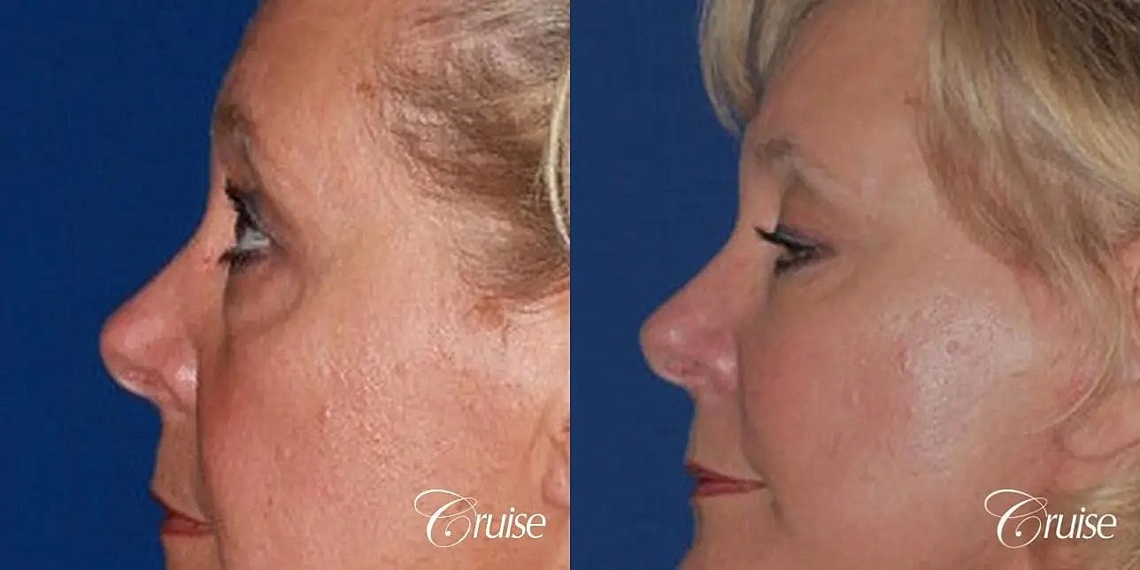 Blepharoplasty Before & After