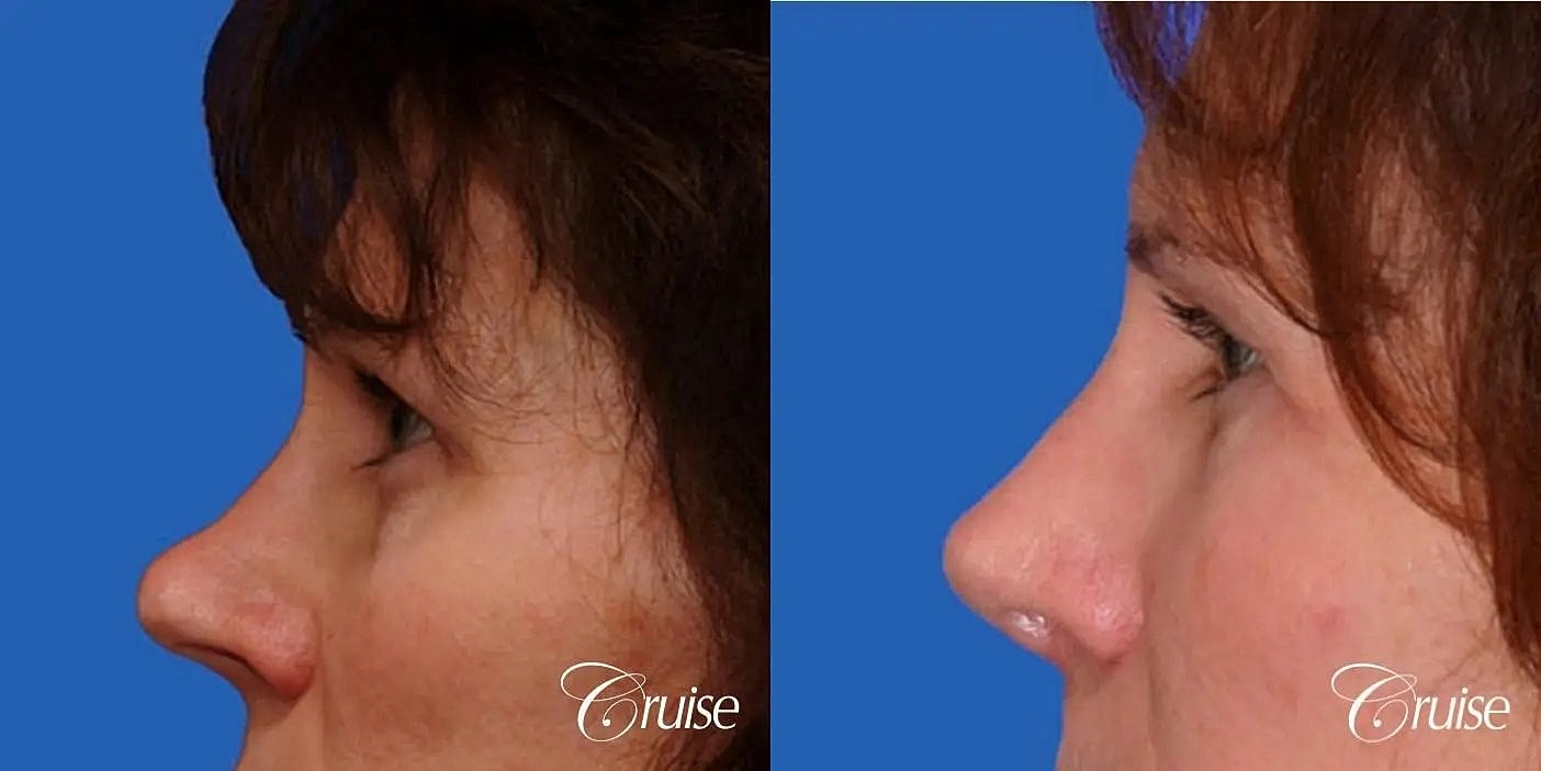 Blepharoplasty Before & After