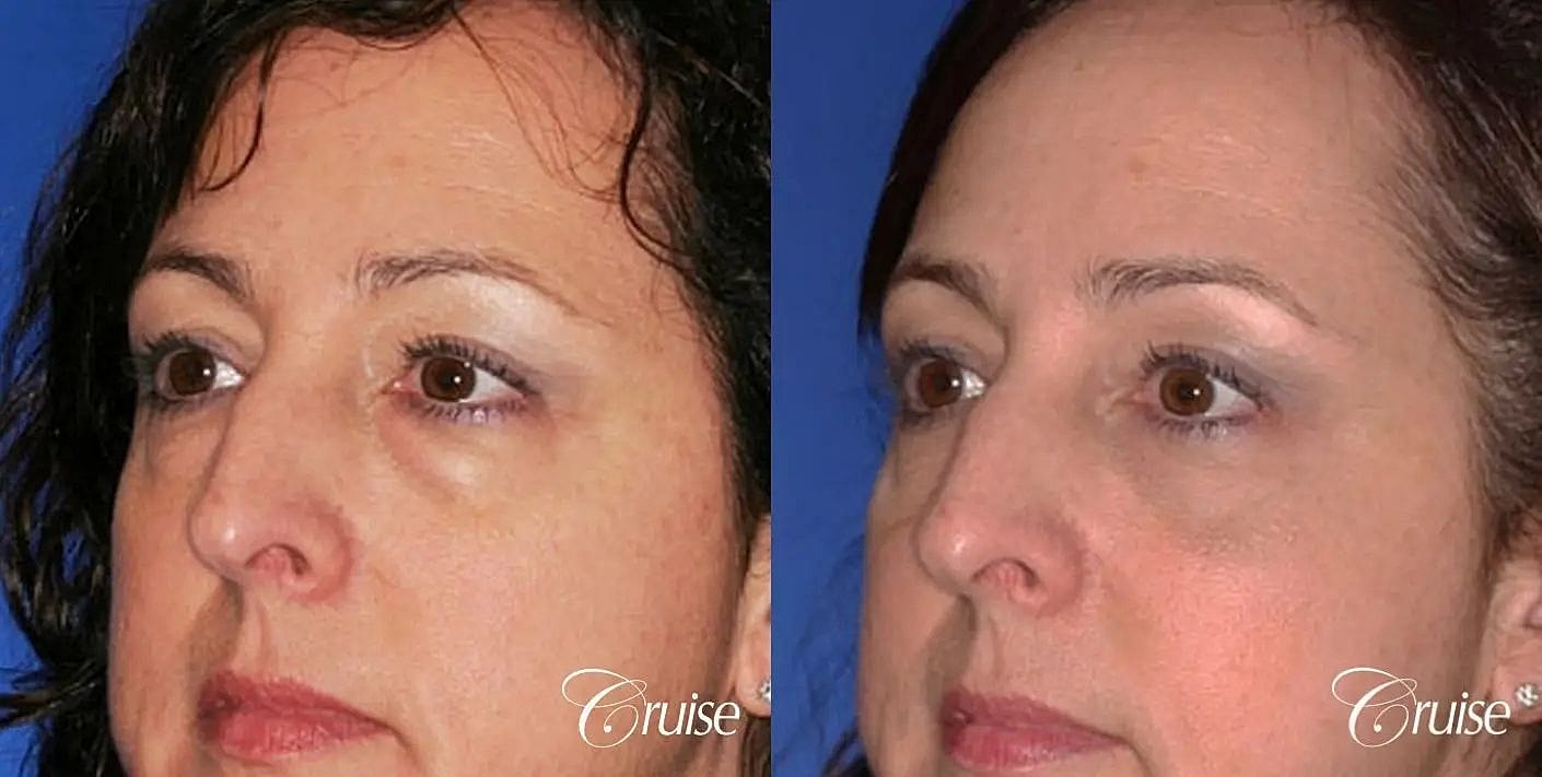 Blepharoplasty Before & After