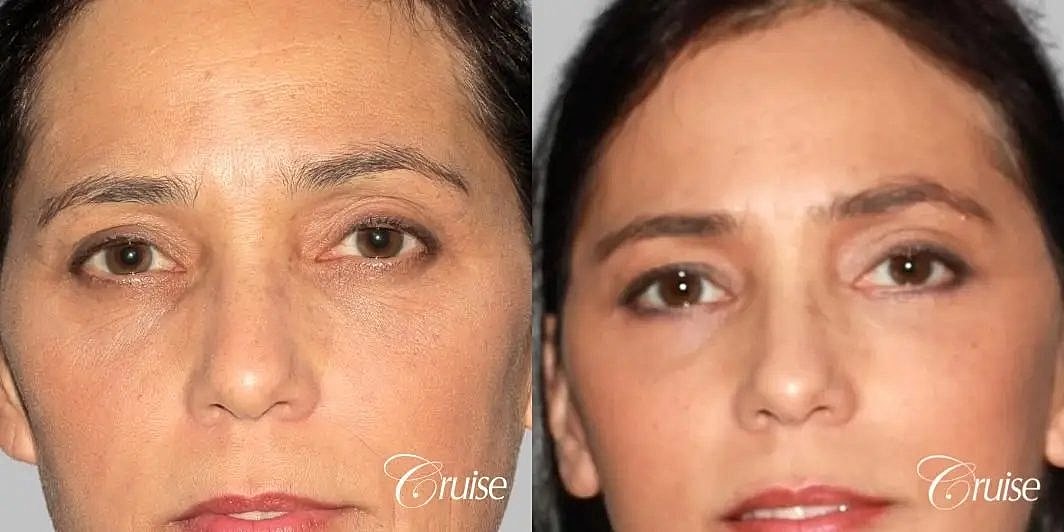 Blepharoplasty Before & After