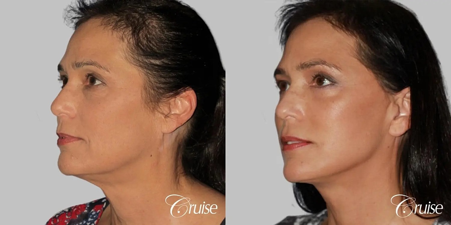 Blepharoplasty Before & After