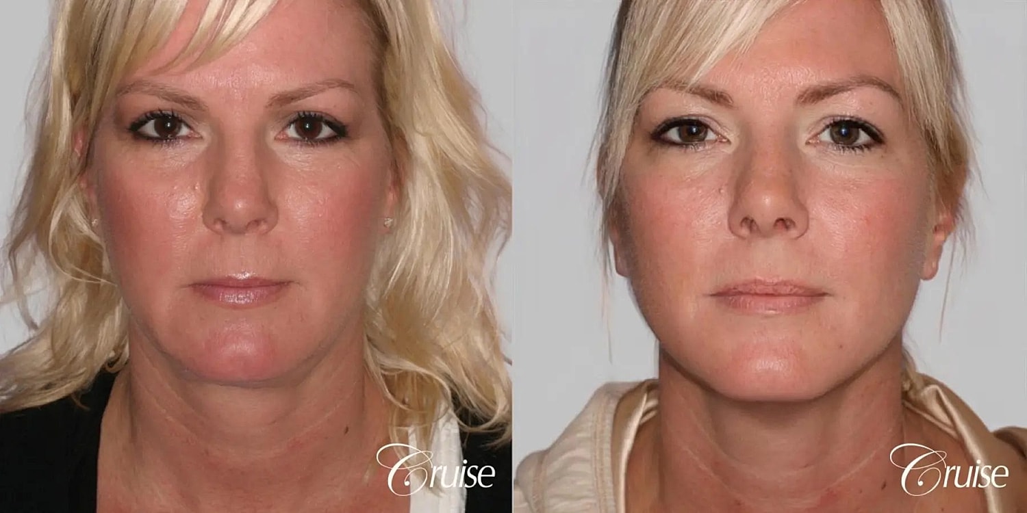Face Lift Before & After