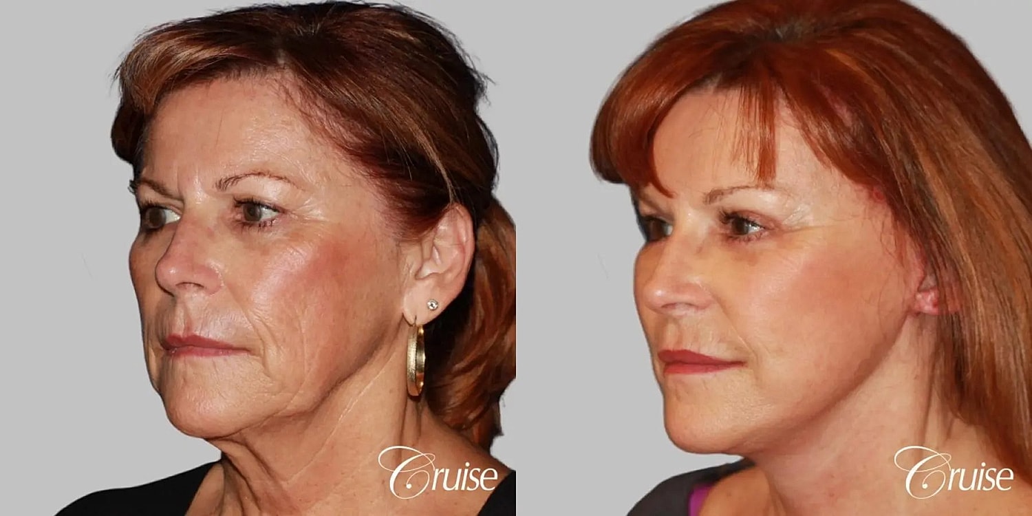 Face Lift Before & After