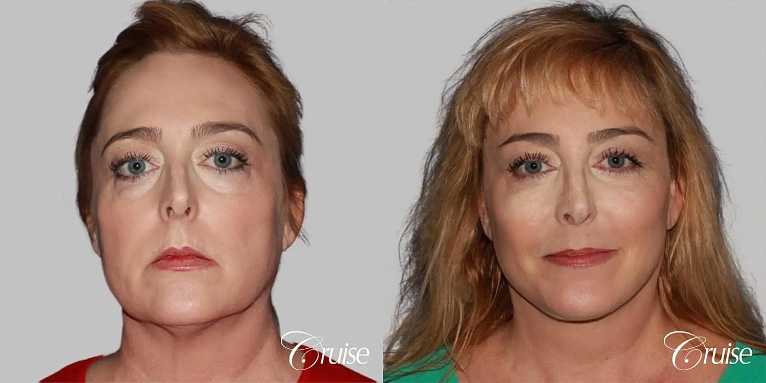 Face Lift Before & After