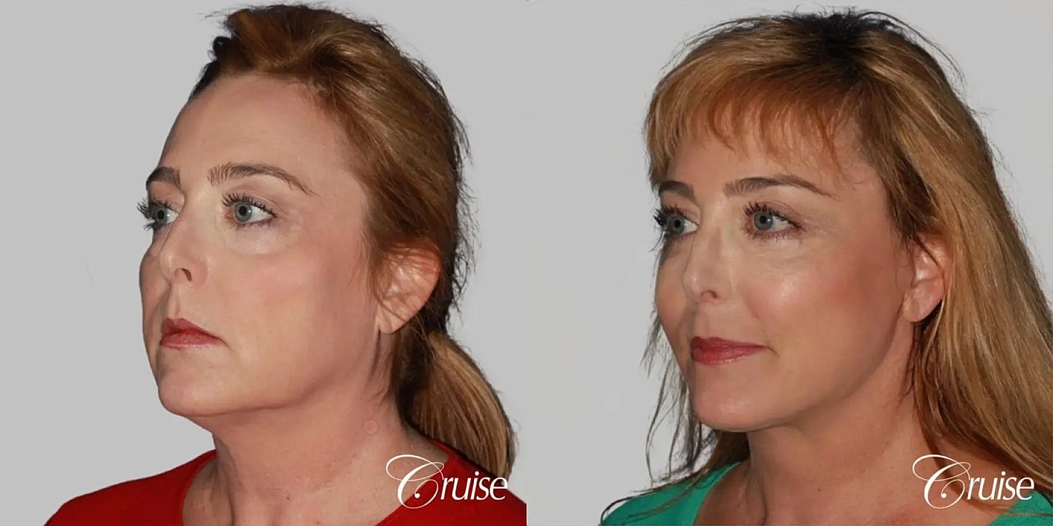 Face Lift Before & After