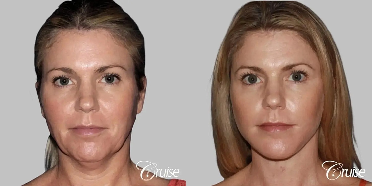 Face Lift Before & After