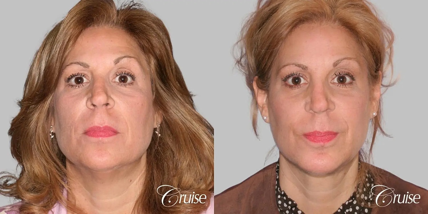 Face Lift Before & After