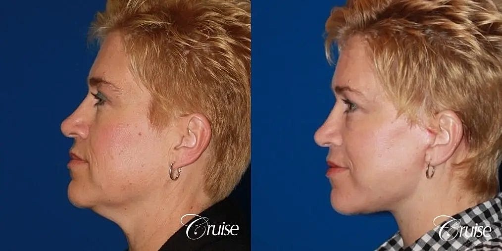 Face Lift Before & After