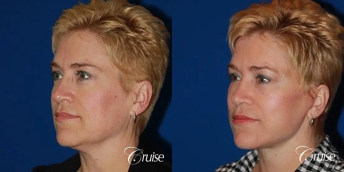 Face Lift Before & After