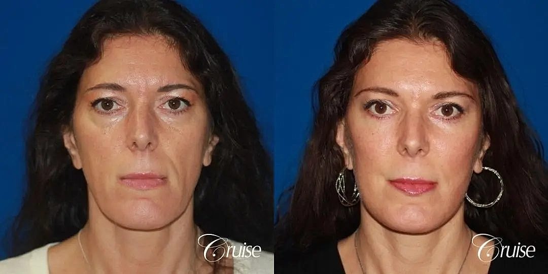Face Lift Before & After