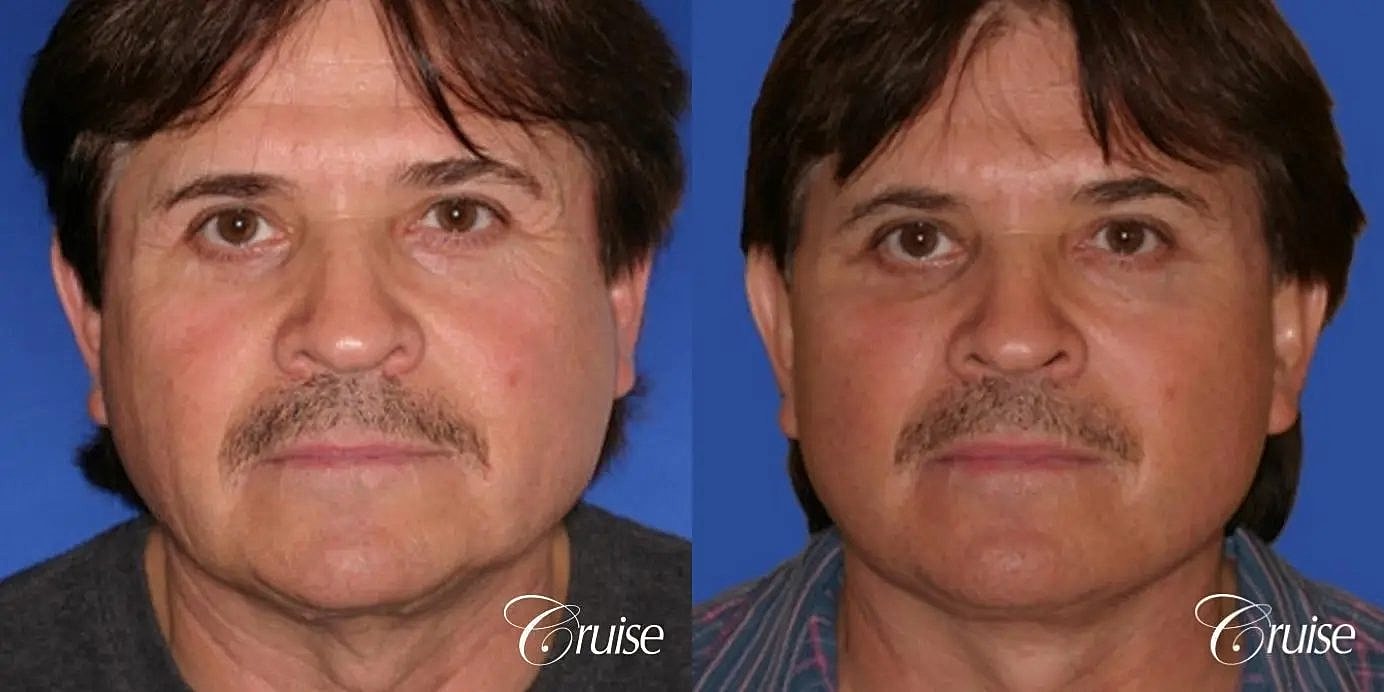 Face Lift Before & After