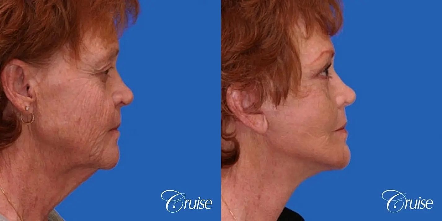 Face Lift Before & After