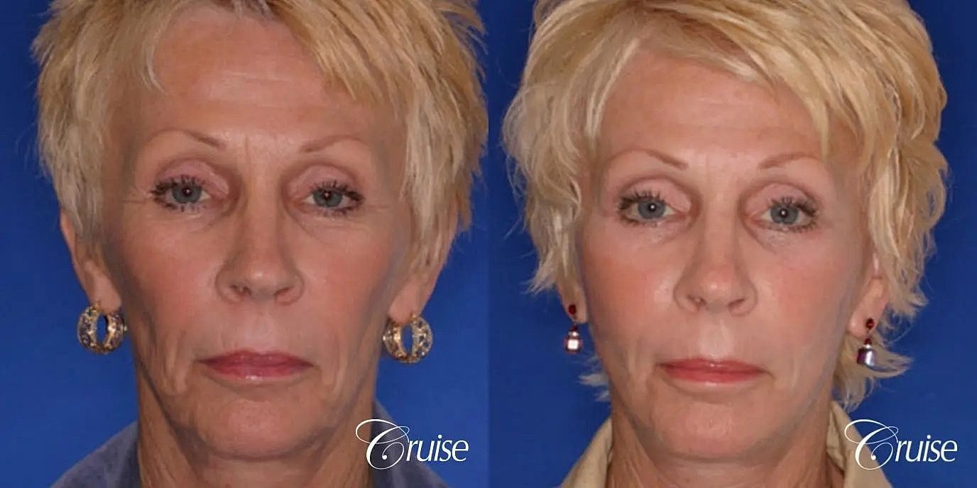 Face Lift Before & After
