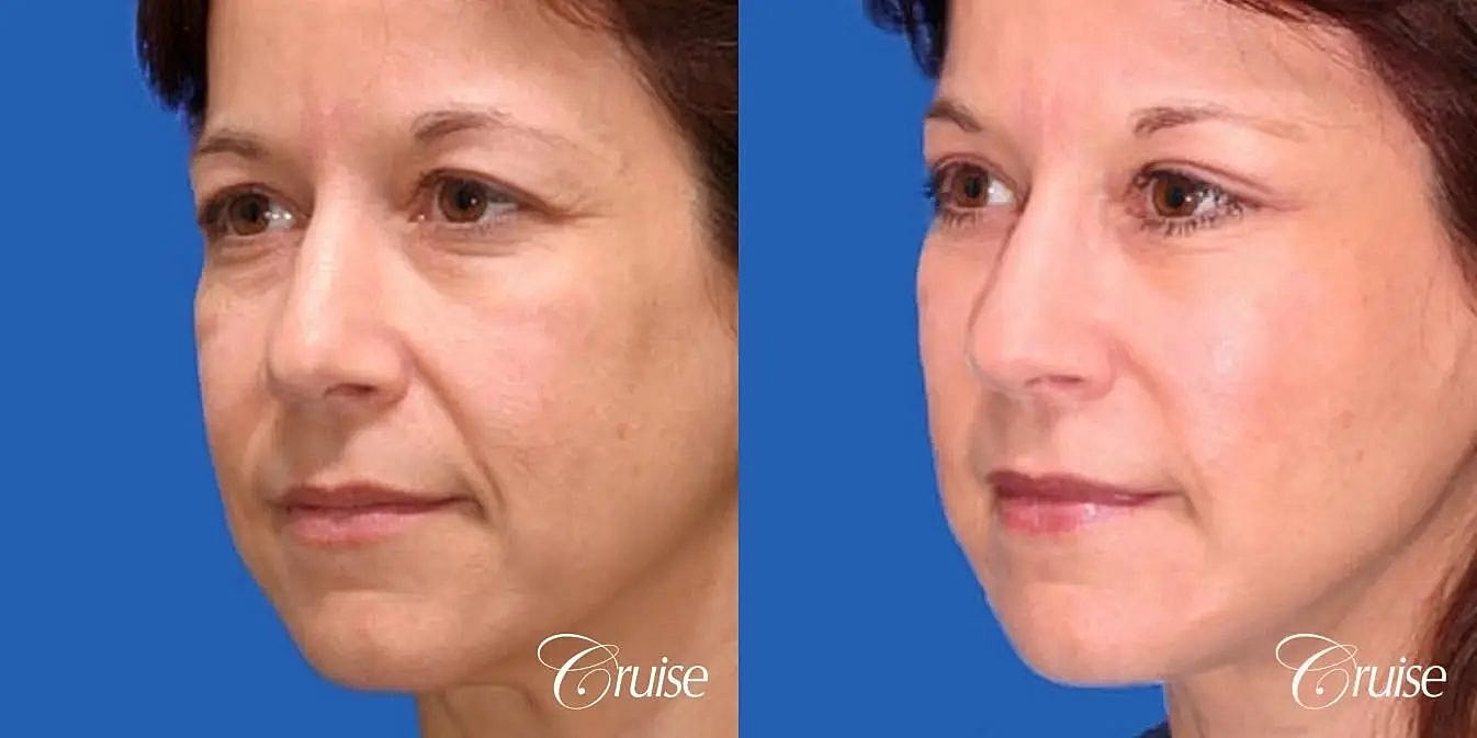 Face Lift Before & After