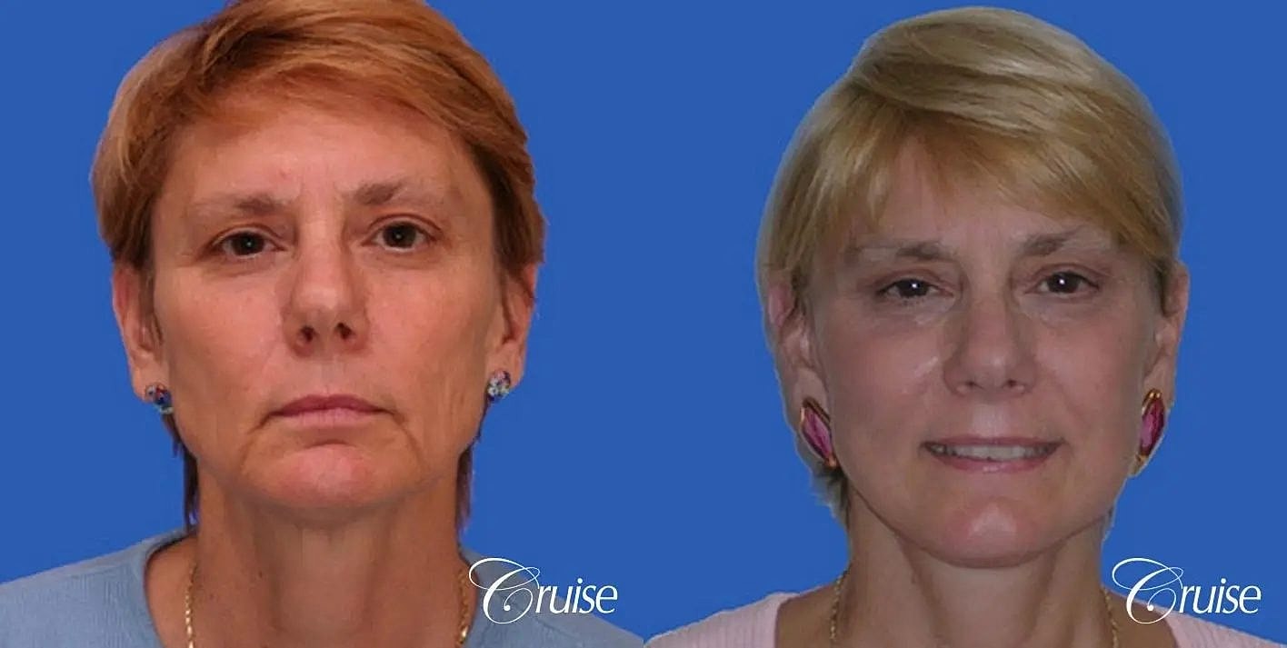 Face Lift Before & After