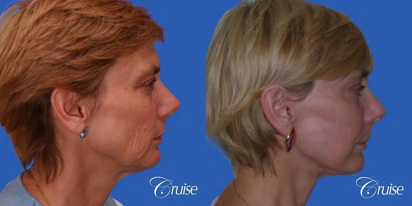 Face Lift Before & After