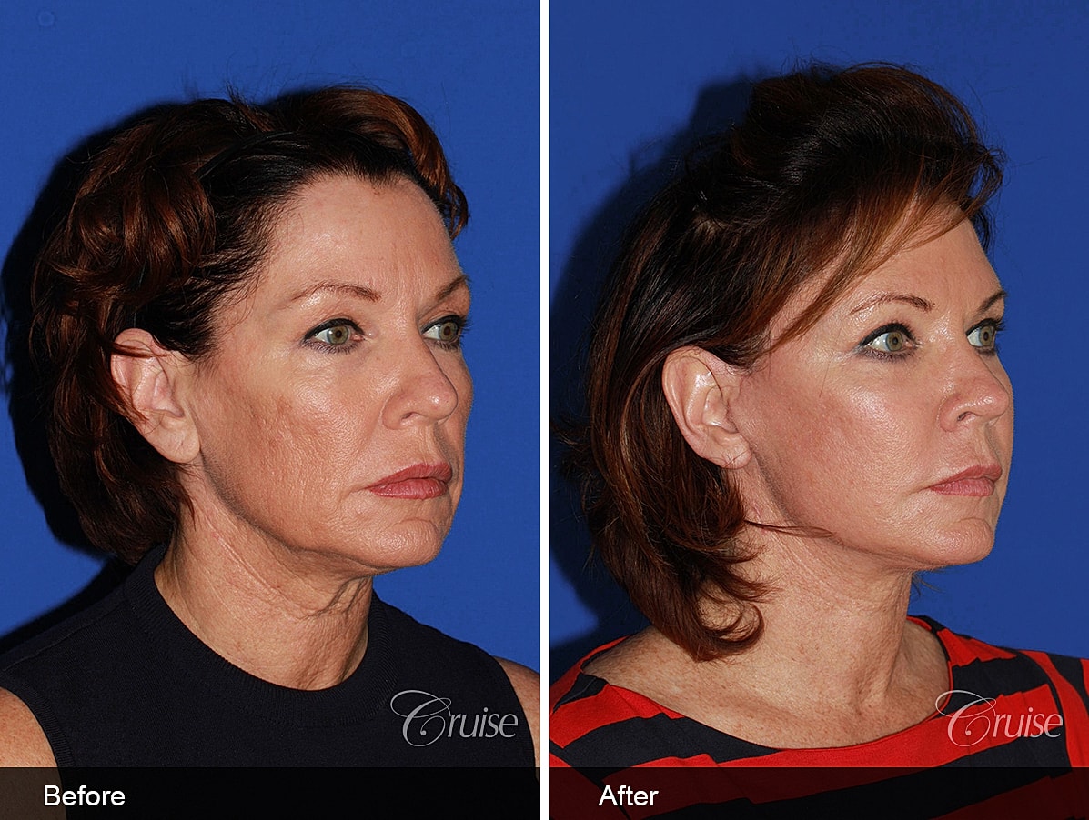 Face Lift Before & After