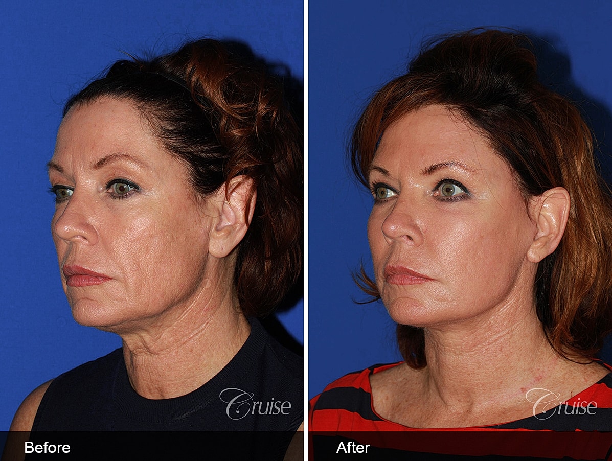 Face Lift Before & After