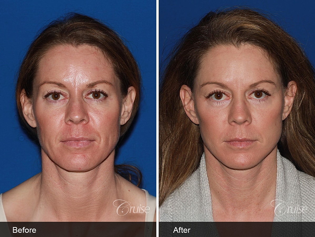 Face Lift Before & After