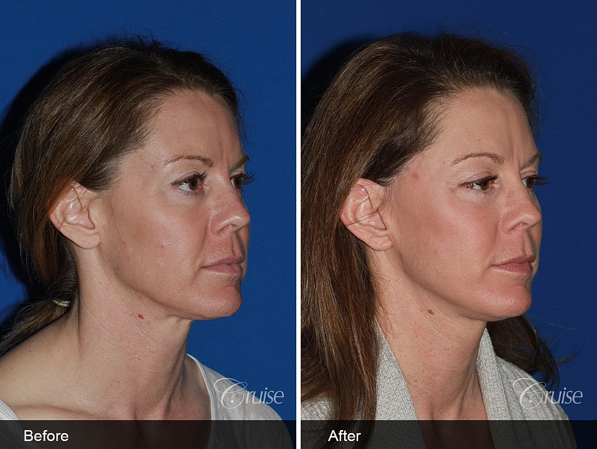 Face Lift Before & After
