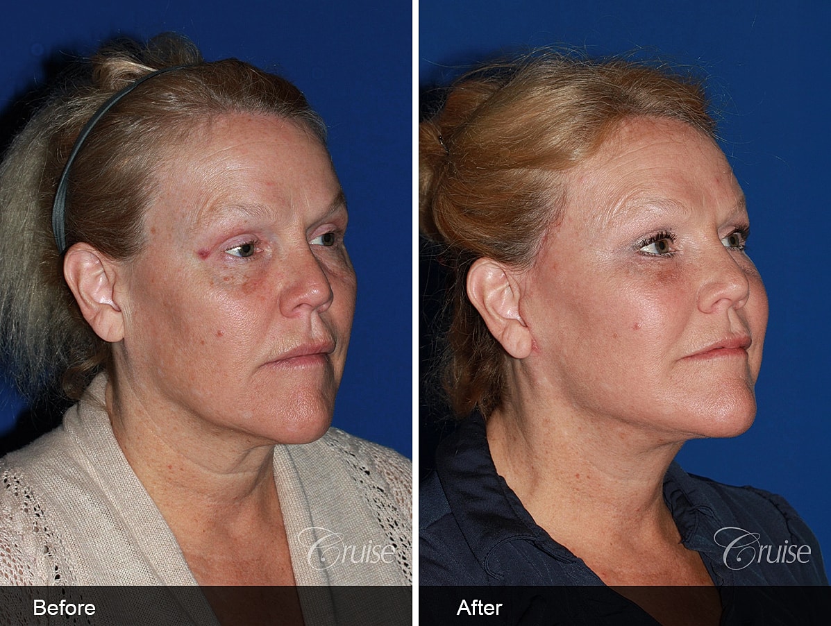 Face Lift Before & After